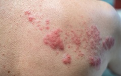 A Holistic Approach to Herpes Viruses